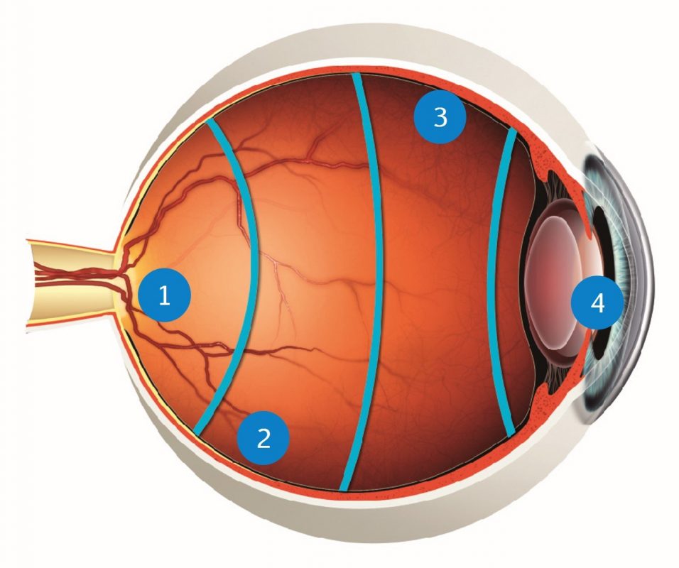 Knipperen Grommen opgroeien Disposable three mirror lens - FCI